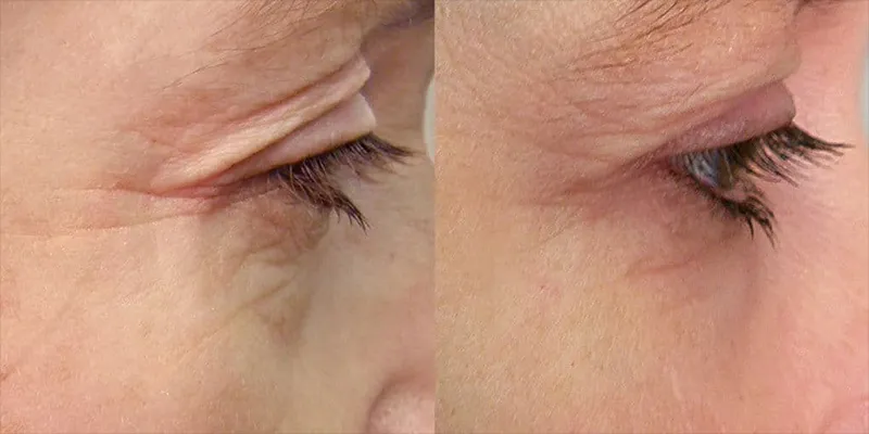 What is Red Light Therapy, and What Does It Do?